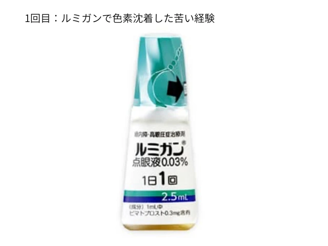 1回目：ルミガンで色素沈着した苦い経験