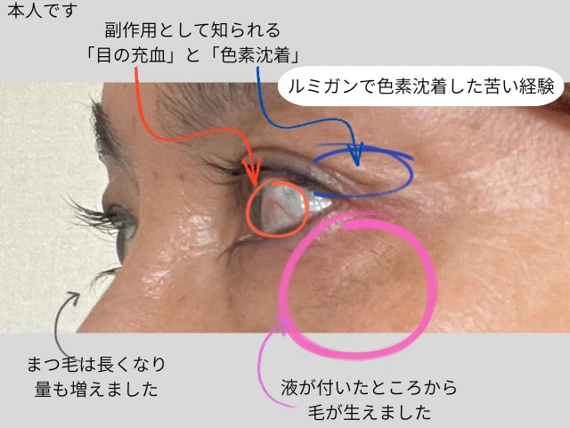 ルミガンで色素沈着した苦い経験