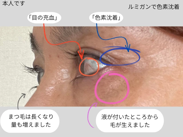 ルミガンで色素沈着