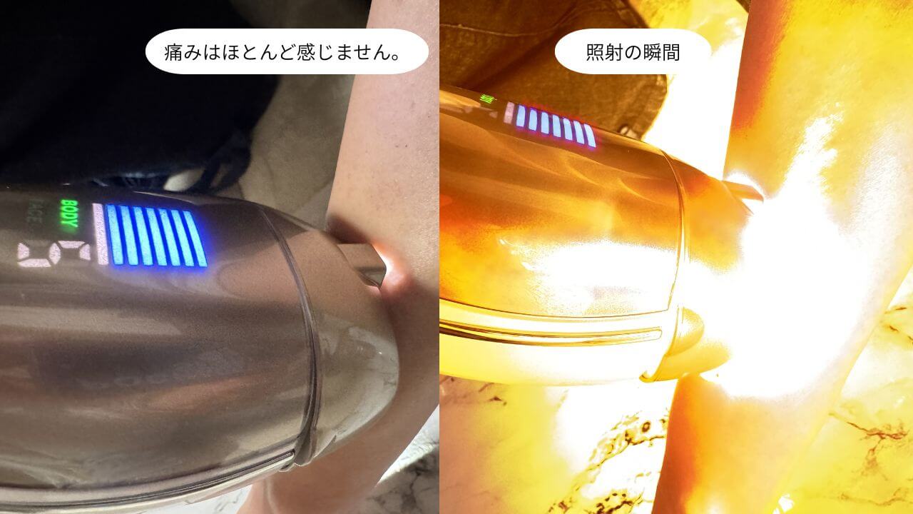 痛みはほとんど感じません。